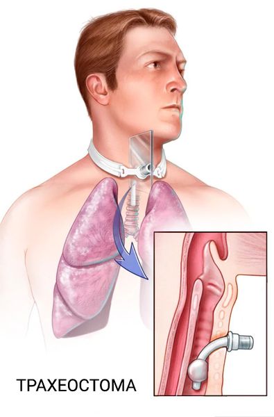 Трахеостома [19]