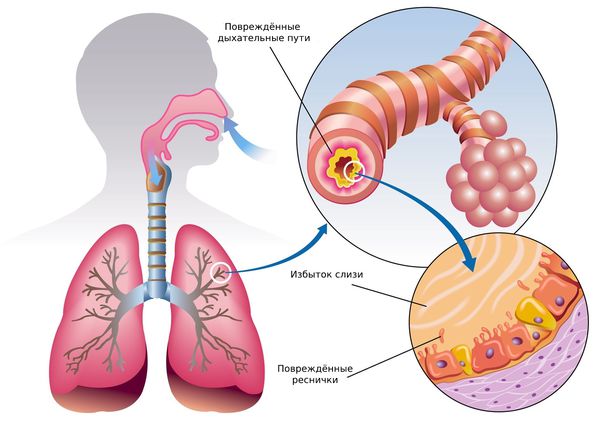 Причины развития трахеита