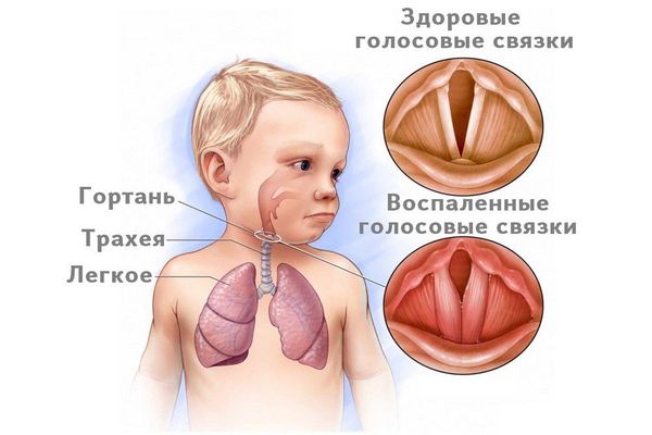 Ложный круп