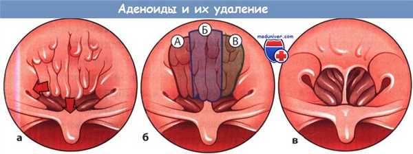 Аденоиды и их удаление