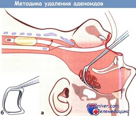Методика удаления аденоидов