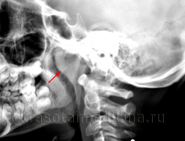 Гипертрофия нёбных миндалин