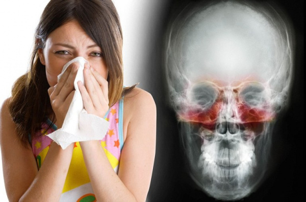 Хронический синусит