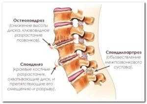 Наросты на позвоночнике