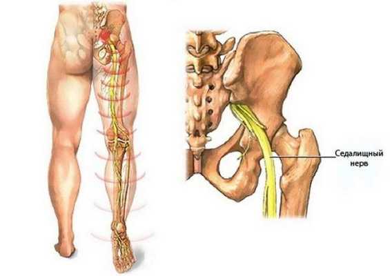Ишиалгия - воспаление седалищного нерва
