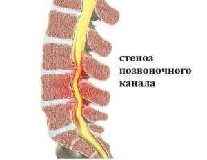 Стеноз (сужение) позвоночного канала