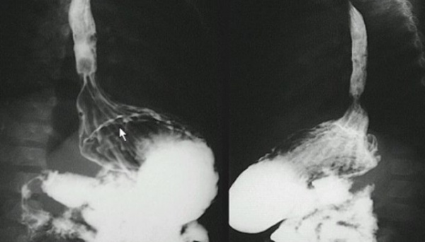 Короткий пищевод