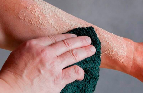 Химические ожоги