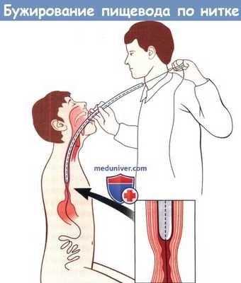 бужирование пищевода по нитке