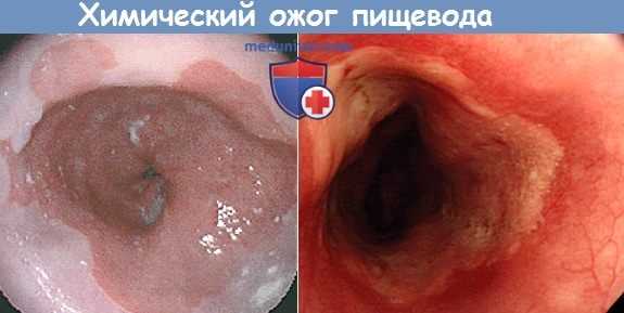 Эзофагоскопия при химическом ожоге пищевода