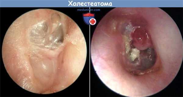 Холестеатома наружного слухового прохода
