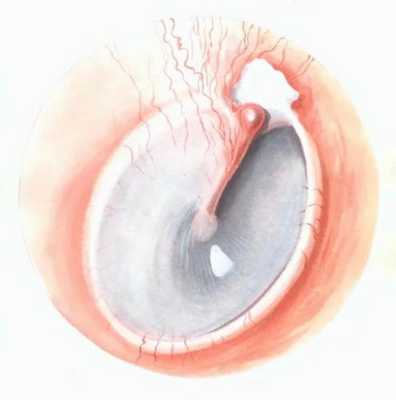 Эпитимпанит