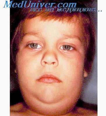 хронический паротит