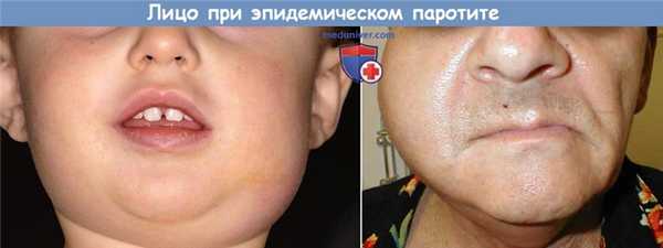 Лицо при свинке (эпидемическом паротите)