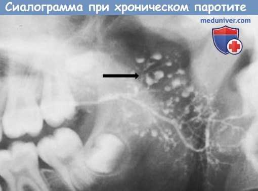 Сиалограмма при хроническом паротите
