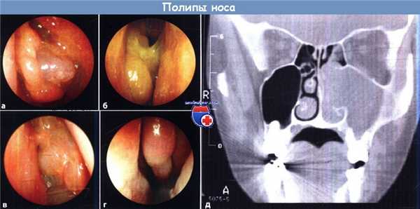 Полипы носа - эндоскопия и КТ