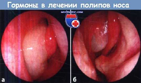 Гормоны в лечении полипов носа