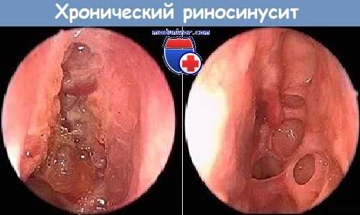 Риноскопия при хроническом риносинусите