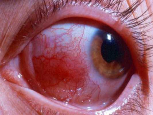 лечение склерита