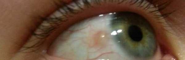 склерит глаза