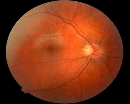Ангиопатия сетчатки глаза