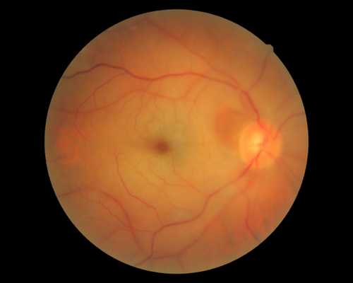 Окклюзия центральной артерии сетчатки