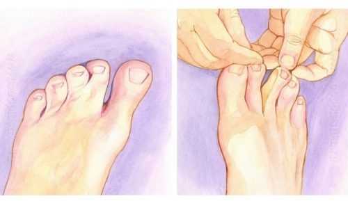 Синдактилия пальцев ног