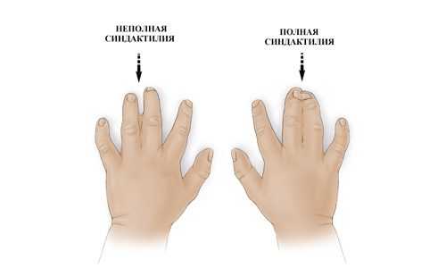 Полная и неполная синдактилия 