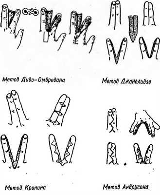 Способы оперативного разделения пальцев