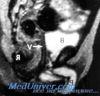 мужской псевдогермафродитизм