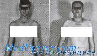 Синдром Клайнфельтера