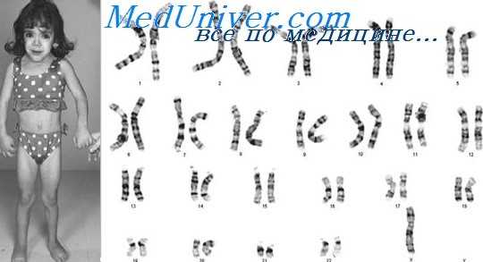 Синдром Тернера