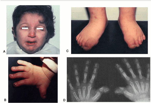 Особенности синдрома Адамса-Оливера: генетика, диагностика и лечение