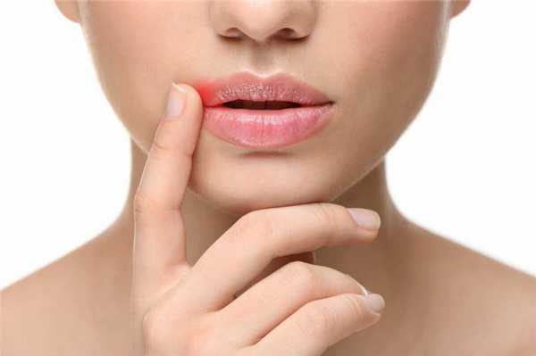 Герпес при тяжелой нейтропении