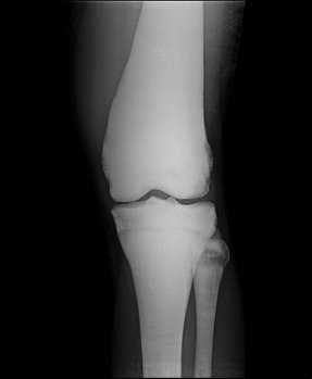 Рентгенограмма костей бедра и голени при мраморной болезни