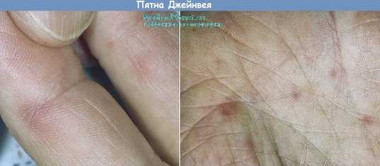 Что такое пятна Джейнвея (Janeway)?