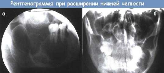 Увеличение нижней челюсти - причины, диагностика, лечение