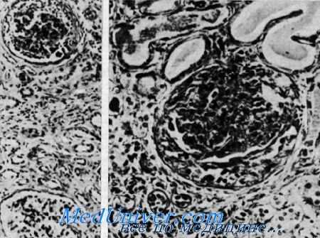 синдром Альпорта