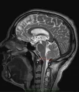 arnold chiari - 2010