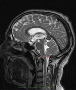 arnold chiari - evolucion_seccion_filum_terminale_2008_caso-16453