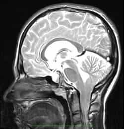 arnold chiari - tension_filum_terminale_02