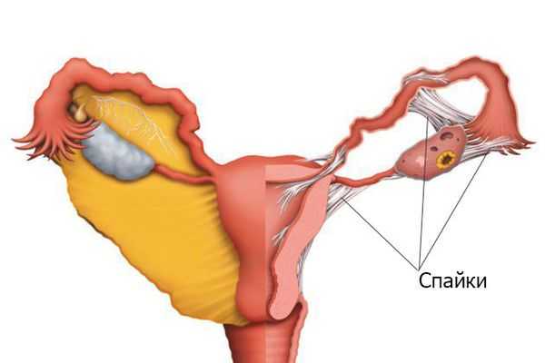 Спайки в маточных трубах