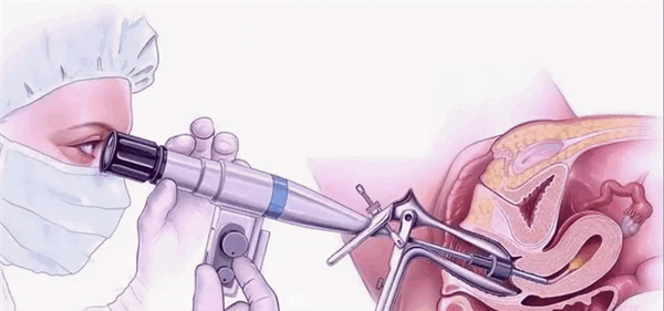 Как делают гистероскопию эндометрия