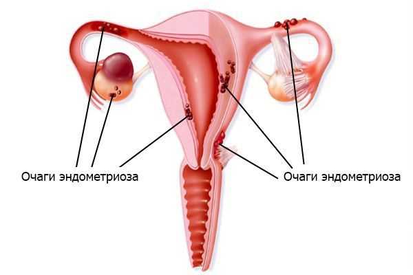 Очаги эндометриоза