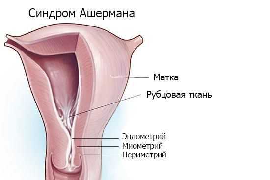 Внутриматочные сращения — синдром Ашермана