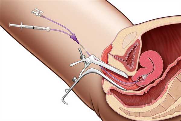 Внутриматочные синехии