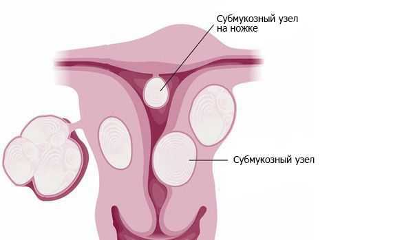 Субмукозные узлы