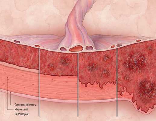 Степени врастания плаценты