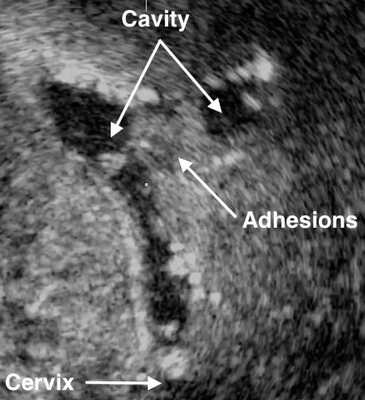 Ультразвуковое изображение внутриматочных спаек.