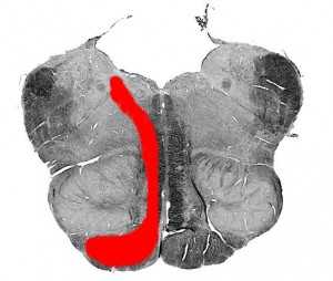 Синдром Авеллиса (срез)